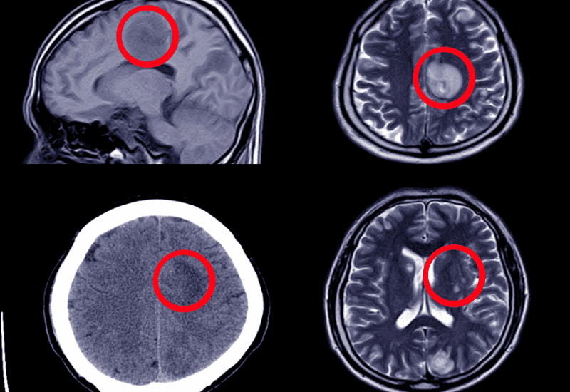 brain scans for normal pressure hydrocephalus