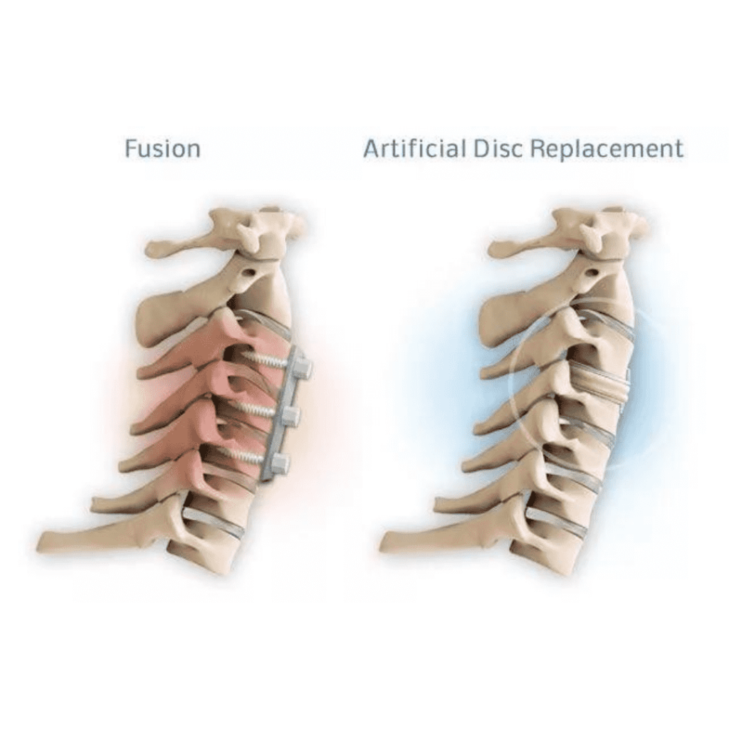 Difference between artificial disc replacement and fusion