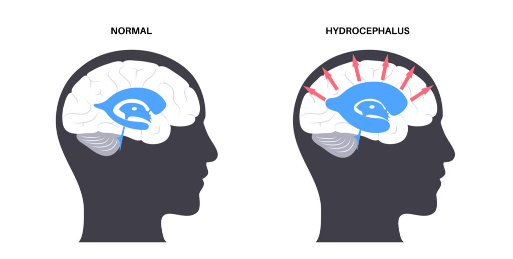 Picture showing difference between a healthy and normal pressure hydrocephalus brain