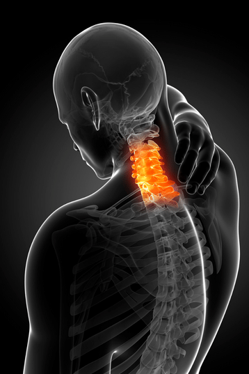 A human model showing symptoms of Cervical Radiculopathy