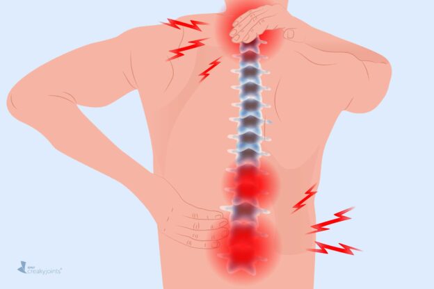 How to Reduce Inflammation in Your Spine