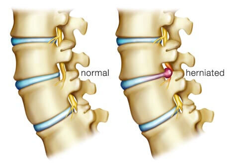 Spine Surgeon for herniated discs