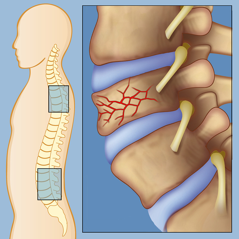 spinal fractures