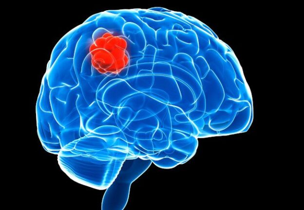 Reducing risk of brain tumor