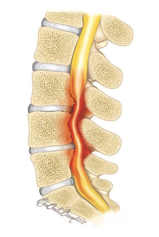 Los Angeles Spine Surgeons can help on Spinal Stenosis