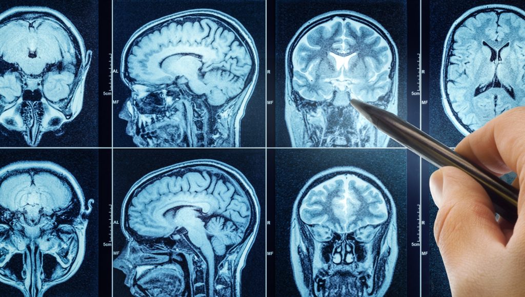 Expert Care for Ganglioglioma Brain Tumor in Los Angeles