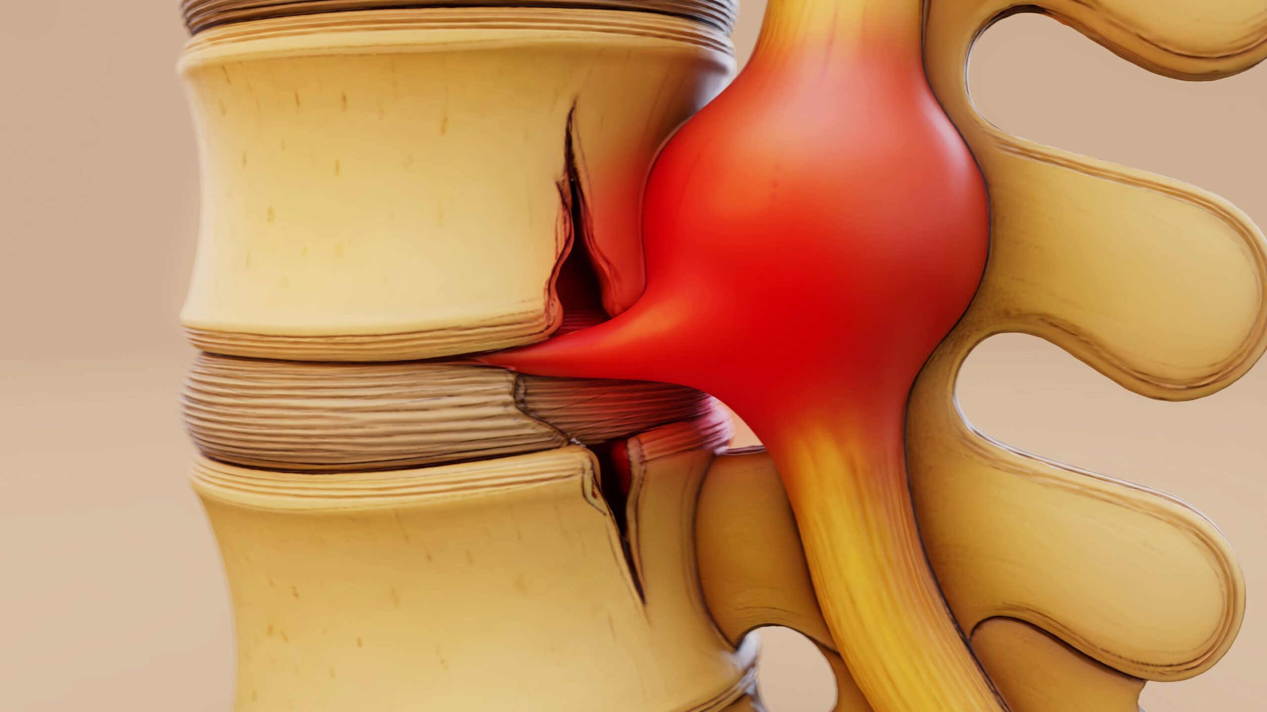 3D medical illustration of a lumbar herniated disc compressing a spinal nerve root, demonstrating a common cause of lumbar spinal disorders and sciatica pain.